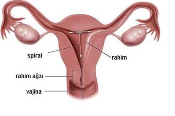 spiral nedir ve nasıl takılır